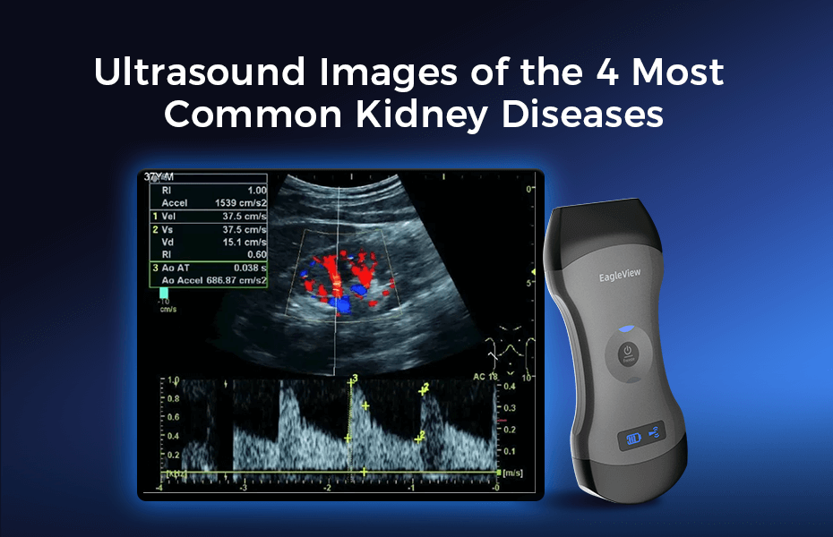 Kidney Ultrasound Images (POCUS): 4 Common Conditions and Scan
