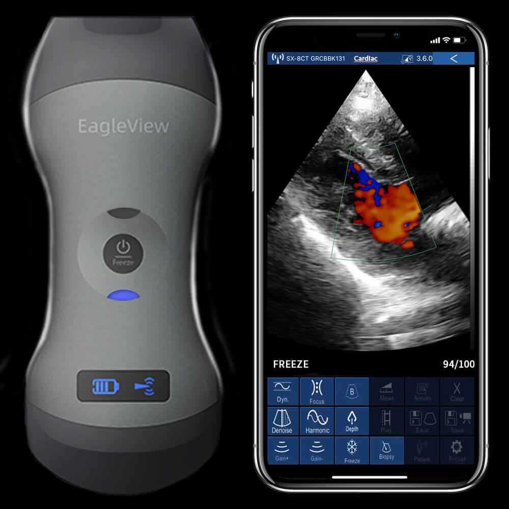 EagleView Portable Wireless Ultrasound Machine with Linear, Convex and  Phased Array Probe. Compatible with iOS and Android.
