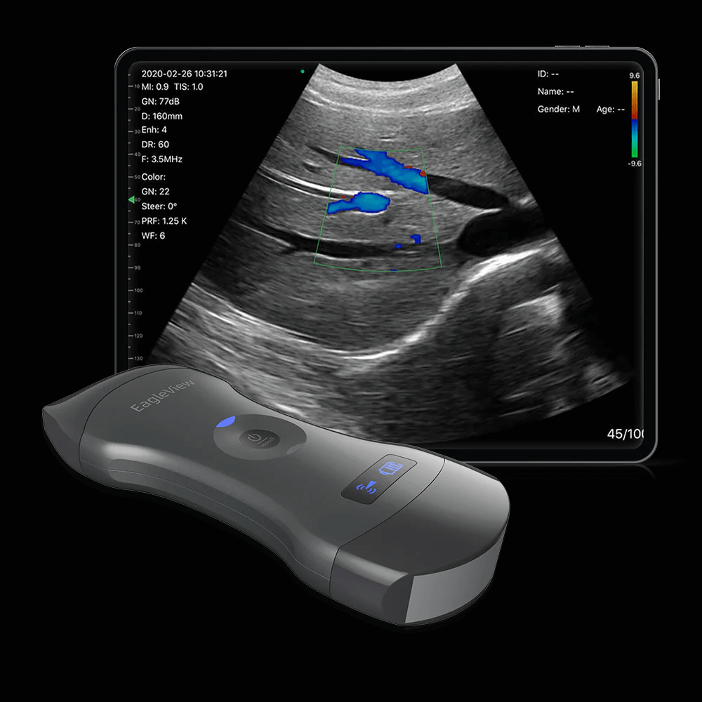 Wireless Probe Type Ultrasound Scanner