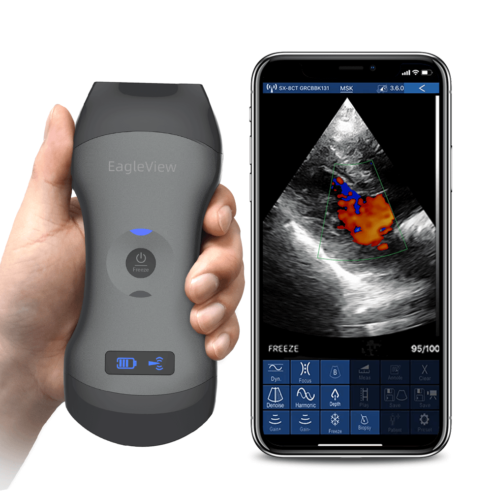 Eagleview portable ultrasound scanner