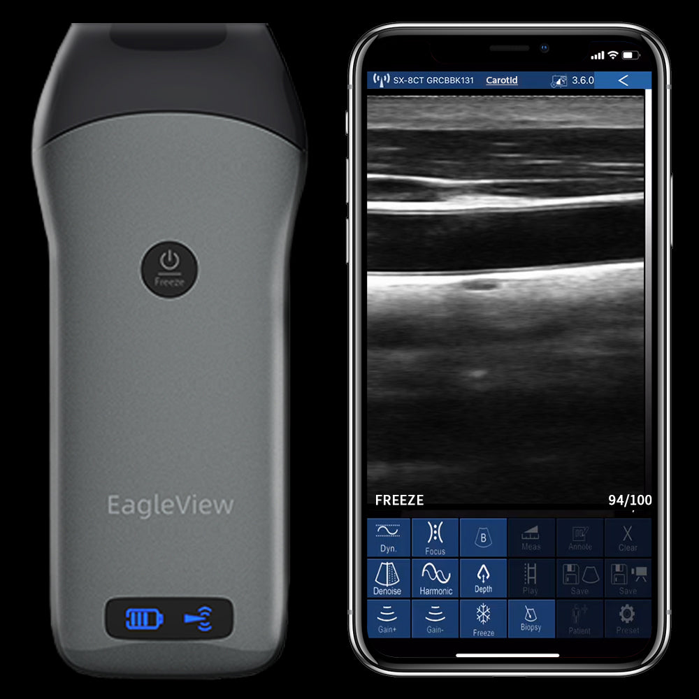 Aparatul cu ultrasunete portabil fără fir liniar EagleView arată imaginea carotidei pe iPhone.